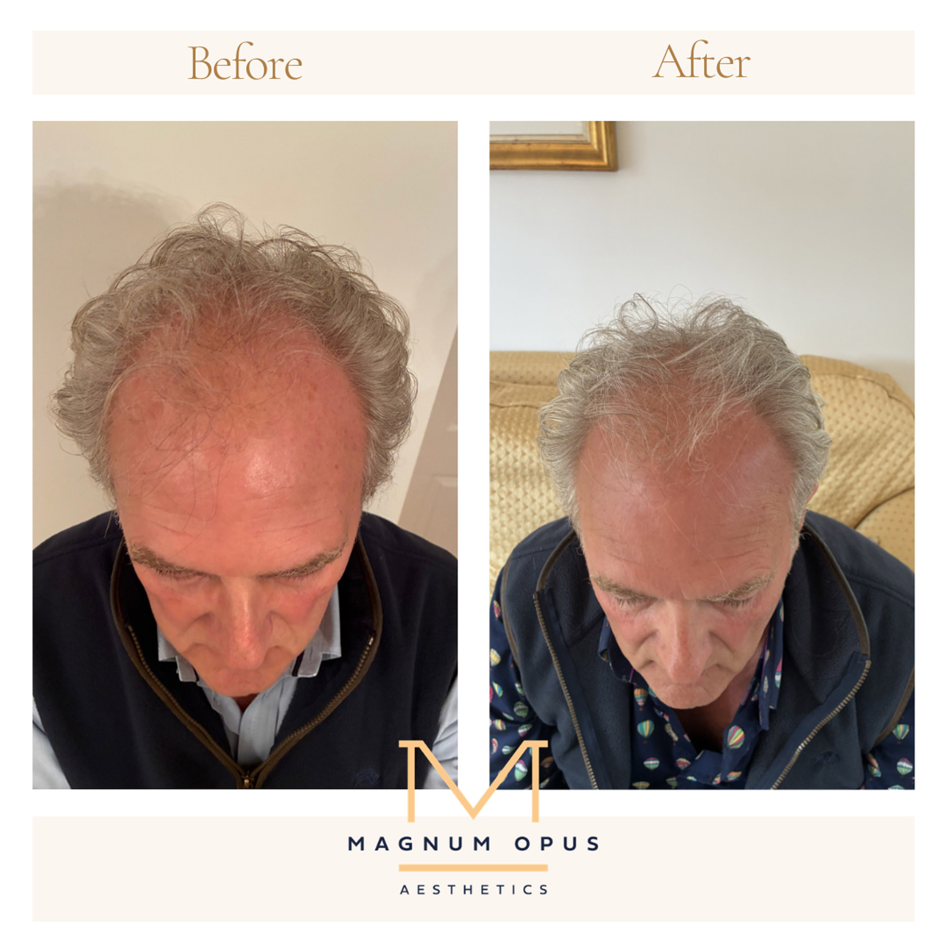 Neutral Before And After